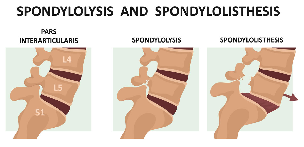 Spondylolysis - Recover Physio Hastings